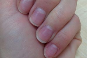 Продольные полоски на ногтях
