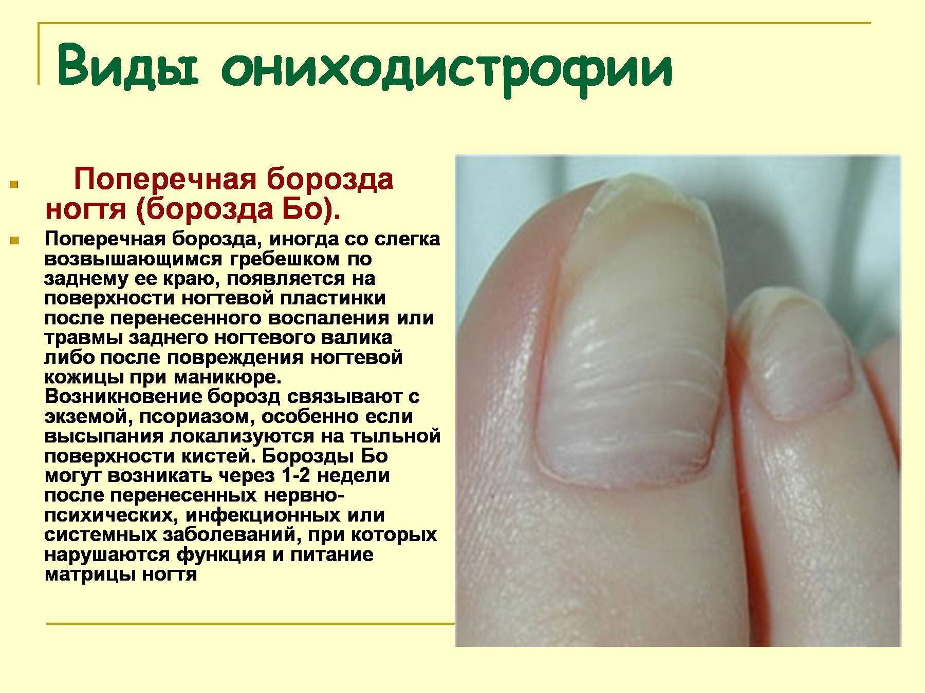 Причины борозд на ногтях