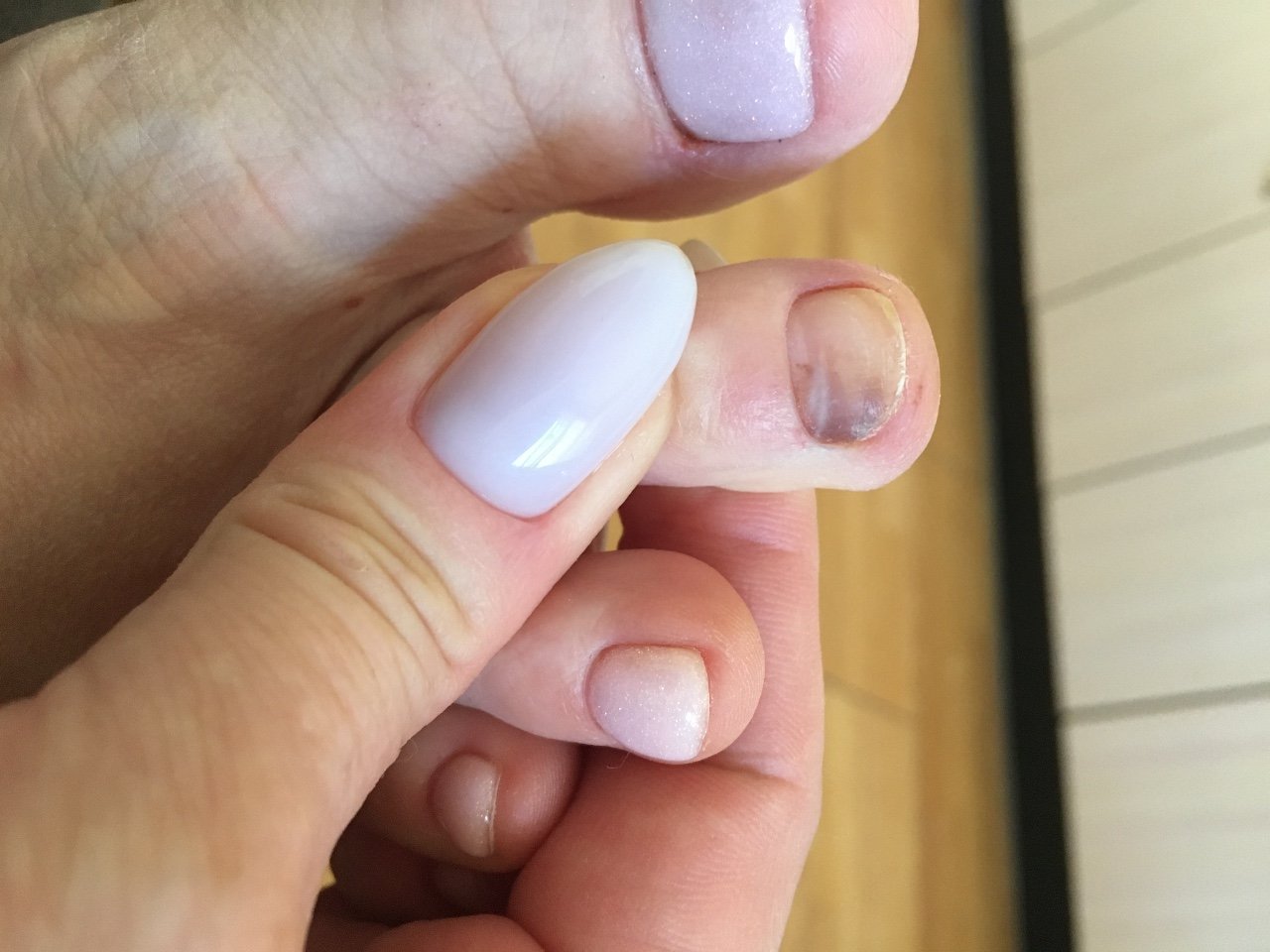 Воспаление кожи вокруг ногтя на руке