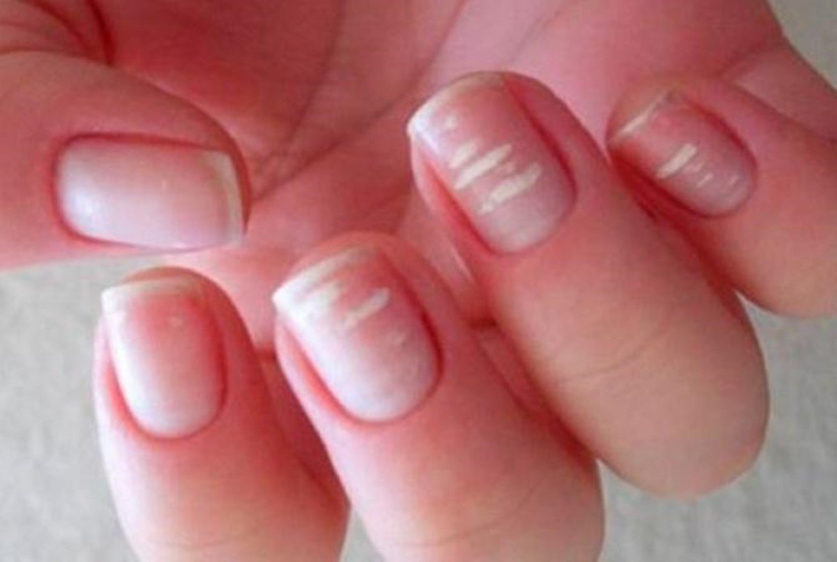 Что означают белые пятна на ногтях рук. Микотическая лейконихия. Лейконихия белые пятна на ногтях.