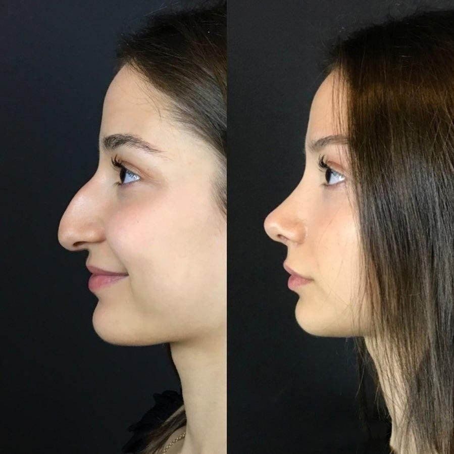 Исправление горбинки носа