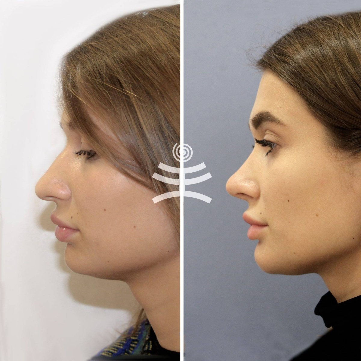 Греческий профиль нос с горбинкой