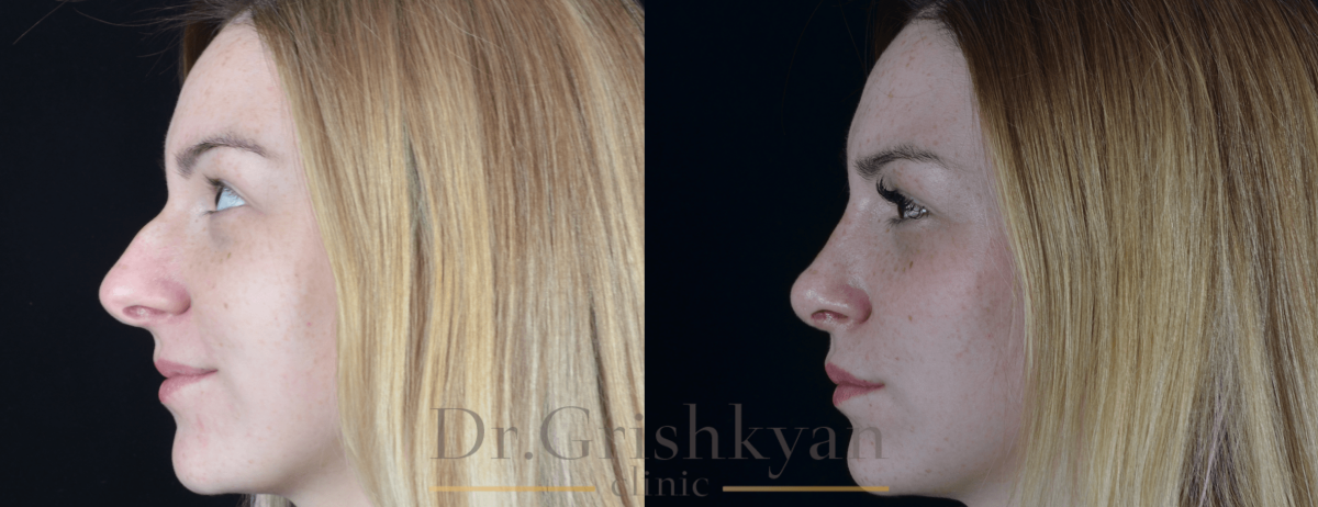 Хайбула ринопластика в Махачкале